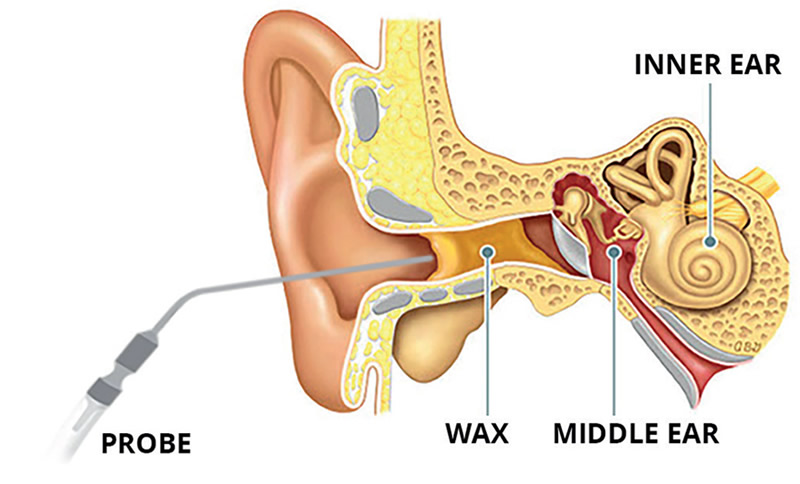 Microsuction (Ear wax removal)
